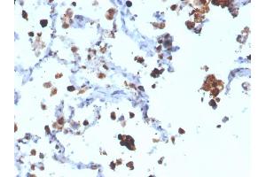 Formalin-fixed, paraffin-embedded human Lung Adenocarcinoma stained with Napsin A Mouse Monoclonal Antibody (NAPSA/3308). (NAPSA anticorps  (AA 189-299))