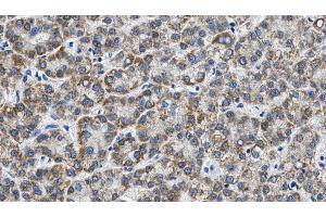 ABIN6268691 at 1/100 staining Human liver cancer tissue by IHC-P. (TJP1 anticorps)
