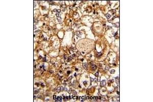 Formalin-fixed and paraffin-embedded human breast carcinoma reacted with C6 Antibody (N-term), which was peroxidase-conjugated to the secondary antibody, followed by DAB staining.