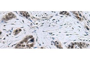 Immunohistochemistry of paraffin-embedded Human thyroid cancer tissue using CCAR2 Polyclonal Antibody at dilution of 1:40(x200) (CCAR2 anticorps)