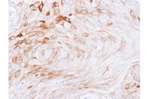 IHC-P Image Immunohistochemical analysis of paraffin-embedded Ca922 xenograft, using BCAT2, antibody at 1:100 dilution.