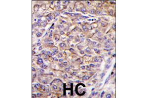 Formalin-fixed and paraffin-embedded human hepatocellular carcinoma reacted with TAOK3 polyclonal antibody  , which was peroxidase-conjugated to the secondary antibody, followed by DAB staining . (TAO Kinase 3 anticorps  (C-Term))