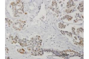 Immunoperoxidase of monoclonal antibody to STK17A on formalin-fixed paraffin-embedded human colon cancer.
