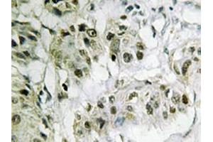 Immunohistochemistry analyzes of CtBP2 antibody in paraffin-embedded human breast carcinoma tissue. (CTBP2 anticorps)