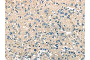 The image on the left is immunohistochemistry of paraffin-embedded Human liver cancer tissue using ABIN7131395(TMPRSS11A Antibody) at dilution 1/30, on the right is treated with fusion protein. (TMPRSS11A anticorps)