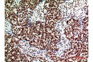 Immunohistochemical analysis of paraffin-embedded human-breast-cancer, antibody was diluted at 1:200