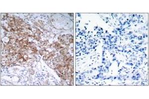 Immunohistochemistry analysis of paraffin-embedded human breast carcinoma tissue, using IGF1R (Ab-1161) Antibody.