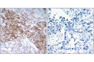 Immunohistochemistry analysis of paraffin-embedded human breast carcinoma tissue, using IGF1R (Ab-1161) Antibody. (IGF1R anticorps  (AA 1126-1175))