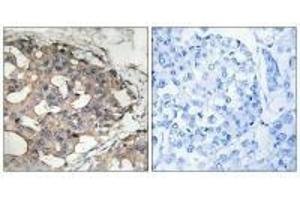 Immunohistochemistry analysis of paraffin-embedded human breast carcinoma tissue using B-RAF (Ab-446) antibody.