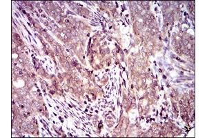 Immunohistochemical analysis of paraffin-embedded cervical cancer tissues using DCTN4 mouse mAb with DAB staining.