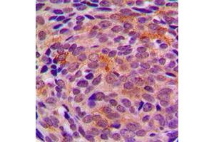 Immunohistochemical analysis of LYPLA1 staining in human breast cancer formalin fixed paraffin embedded tissue section. (LYPLA1 anticorps  (Center))