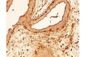 IHC-P: Cofilin antibody testing of human breast cancer tissue (Cofilin anticorps  (AA 2-166))