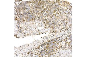 Immunohistochemistry of paraffin-embedded human esophageal cancer using GC1q R/C1QBP antibody (ABIN7266473) at dilution of 1:25 (40x lens).