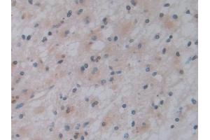 Detection of PTF1a in Human Glioma Tissue using Polyclonal Antibody to Pancreas Specific Transcription Factor 1a (PTF1a)