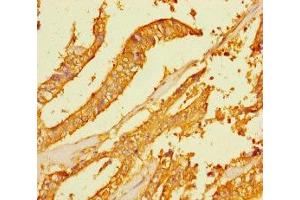 Immunohistochemistry of paraffin-embedded human endometrial cancer using ABIN7165442 at dilution of 1:100 (FAM167A anticorps  (AA 1-214))