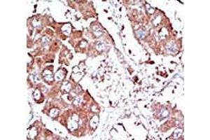 IHC analysis of FFPE human hepatocarcinoma tissue stained with the ALK3 antibody (BMPR1A anticorps  (AA 166-195))