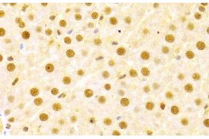 Immunohistochemistry of paraffin-embedded Human liver damage using CDC25A Polyclonal Antibody at dilution of 1:100 (40x lens). (CDC25A anticorps)