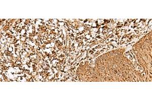 Immunohistochemistry of paraffin-embedded Human esophagus cancer tissue using FAM200A Polyclonal Antibody at dilution of 1:55(x200) (FAM200A anticorps)