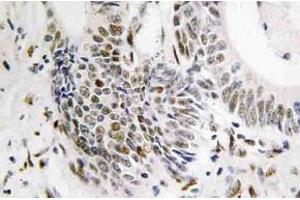 Immunohistochemistry (IHC) analyzes of Rad51 antibody in paraffin-embedded human colon carcinoma tissue. (RAD51 anticorps)