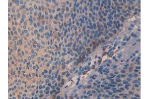 DAB staining on IHC-P; Samples: Human Skin cancer Tissue (SLIT3 anticorps  (AA 1405-1512))