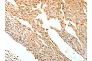 The image on the left is immunohistochemistry of paraffin-embedded Human cervical cancer tissue using ABIN7130780(PTPRE Antibody) at dilution 1/10, on the right is treated with fusion protein. (PTPRE anticorps)