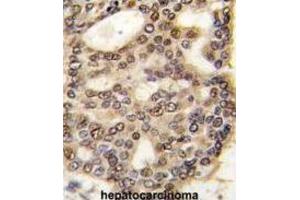 Immunohistochemistry (IHC) image for anti-Hepatoma-Derived Growth Factor (HDGF) antibody (ABIN3002632) (HDGF anticorps)
