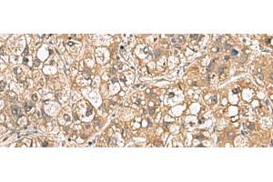 Immunohistochemistry of paraffin-embedded Human liver cancer tissue using PTPRS Polyclonal Antibody at dilution of 1:110(x200) (PTPRS anticorps)