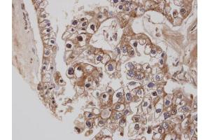 IHC-P Image Immunohistochemical analysis of paraffin-embedded human ovarian cancer, using CB1 , antibody at 1:100 dilution. (CNR1 anticorps  (C-Term))
