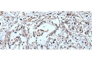 Immunohistochemistry of paraffin-embedded Human gastric cancer tissue using GJA5 Polyclonal Antibody at dilution of 1:50(x200) (Cx40/GJA5 anticorps)