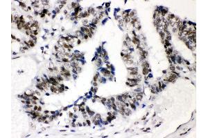 IHC(P): Human Intestinal Cancer Tissue