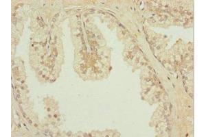 Immunohistochemistry of paraffin-embedded human prostate cancer using ABIN7156889 at dilution of 1:100 (IL31RA anticorps  (AA 1-300))
