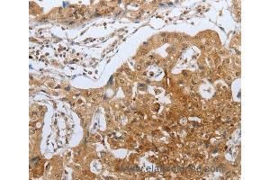 Immunohistochemistry of Human lung cancer using CASP12 Polyclonal Antibody at dilution of 1:50 (Caspase 12 anticorps)