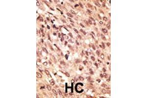 Formalin-fixed and paraffin-embedded human hepatocellular carcinoma tissue reacted with LRP5 polyclonal antibody , which was peroxidase-conjugated to the secondary antibody, followed by AEC staining. (LRP5 anticorps  (C-Term))