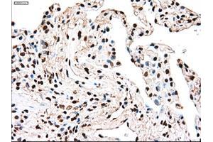 Immunohistochemical staining of paraffin-embedded Adenocarcinoma of breast tissue using anti-TYRO3 mouse monoclonal antibody. (TYRO3 anticorps)