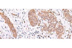 Immunohistochemistry of paraffin-embedded Human esophagus cancer tissue using RUSC1 Polyclonal Antibody at dilution of 1:90(x200) (RUSC1 anticorps)