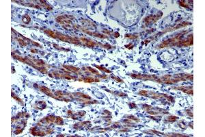 Formalin-fixed, paraffin-embedded human Leiomyosarcoma stained with Caldesmon Mouse Monoclonal Antibody (h-CALD). (Caldesmon anticorps)
