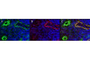 Immunohistochemistry detection of endogenous LYVE-1 in cryo sections of human colon carcinoma using anti-LYVE-1 (human), pAb  (red) and anti-human CD31 pAb (green). (LYVE1 anticorps  (AA 24-232))