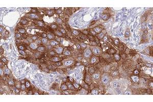 ABIN6276799 at 1/100 staining Human Head and neck cancer tissue by IHC-P.