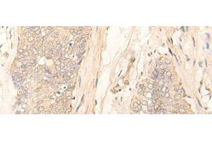 Immunohistochemistry of paraffin-embedded Human esophagus cancer tissue using GK5 Polyclonal Antibody at dilution of 1:35(x200)
