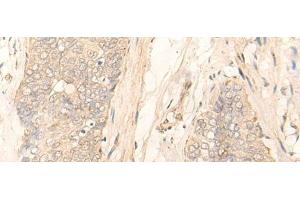 Immunohistochemistry of paraffin-embedded Human esophagus cancer tissue using GK5 Polyclonal Antibody at dilution of 1:35(x200) (GK5 anticorps)