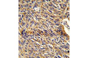 Formalin-fixed and paraffin-embedded human lung carcinoma reacted with DCI Antibody (C-term), which was peroxidase-conjugated to the secondary antibody, followed by DAB staining. (DCI anticorps  (C-Term))