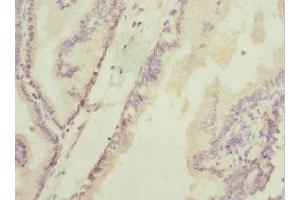 Immunohistochemistry of paraffin-embedded human prostate cancer using ABIN7154846 at dilution of 1:100 (HAND2 anticorps  (AA 1-217))