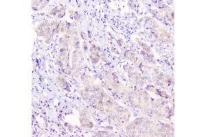 IHC testing of human breast cancer tissue with Cx43 antibody at 1ug/ml.