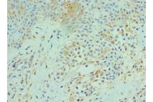 Immunohistochemistry of paraffin-embedded human breast cancer using ABIN7170676 at dilution of 1:100 (SRPK1 anticorps  (AA 290-480))