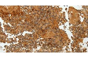 Immunohistochemistry of paraffin-embedded Human tonsil tissue using TFF2 Polyclonal Antibody at dilution 1:40 (Trefoil Factor 2 anticorps)