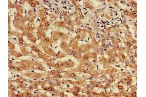 Immunohistochemistry of paraffin-embedded human liver cancer using ABIN7174961 at dilution of 1:100 (Myosin VIIA anticorps  (AA 838-968))