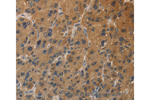 Immunohistochemistry of Human thyroid cancer using DUSP23 Polyclonal Antibody at dilution of 1:30
