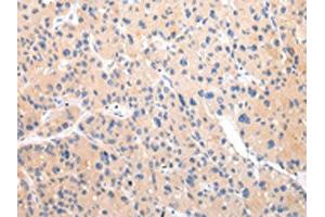The image on the left is immunohistochemistry of paraffin-embedded Human liver cancer tissue using ABIN7193105(ZNF106 Antibody) at dilution 1/20, on the right is treated with synthetic peptide. (ZNF16 anticorps)