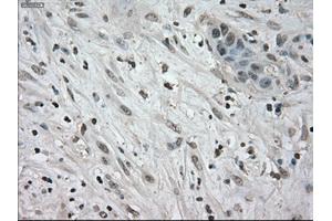 Immunohistochemical staining of paraffin-embedded Carcinoma of kidney tissue using anti-NEK6mouse monoclonal antibody. (NEK6 anticorps)