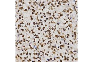 Immunohistochemistry of paraffin-embedded human kidney cancer tissue using H4K20me3 antibody at dilution of 1:200 (x400 lens). (Histone H4 anticorps  (3meLys20))